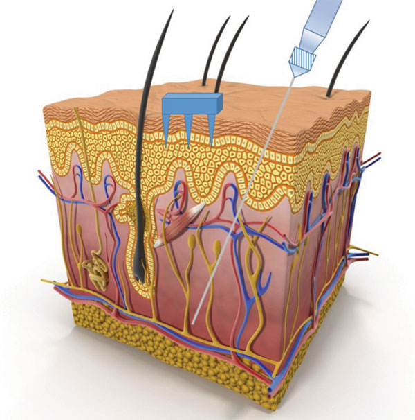 digital illustration of skin layers showing microneedle depth