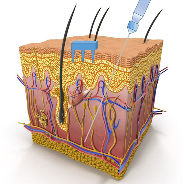 drawing of skin cell layers showing microneedles versus conventional needles